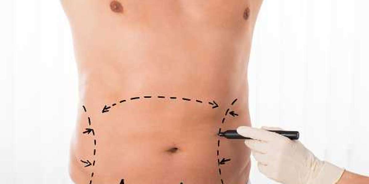 Surprising Facts About Tummy Tuck Surgery That You Never Knew