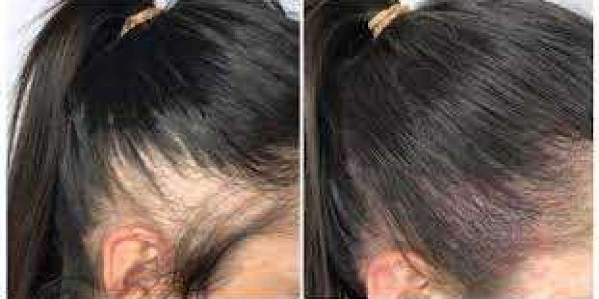 Hair Transplant FUE Results